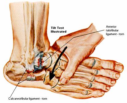 ankle sprain tilt test