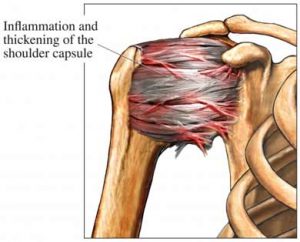 Frozen Shoulder