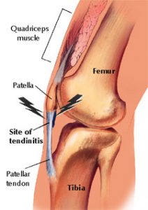 pressure under knee cap