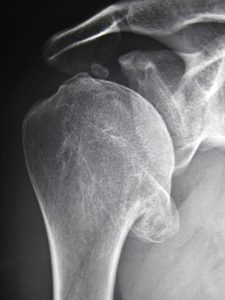 Diagnosing Glenohumeral Arthritis