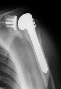 Treating Glenohumeral Arthritis