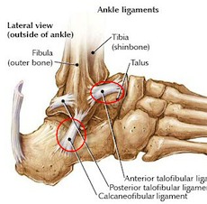 ankle sprain