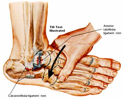 anterior talofibular ligament swelling