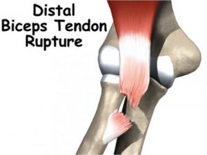 Distal Biceps Tendon Ruptures