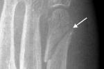 Oblique Fracture