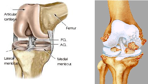 Knee Arthritis – Orland Park Orthopedics