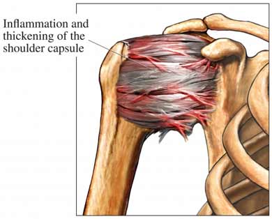 Frozen Shoulder – Orland Park Orthopedics