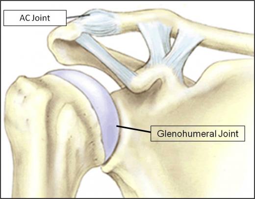 AC Joint Pain - Complete Orthopedics