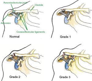 Acromioclavicular Joint Separation (AC separation) – Orland Park ...