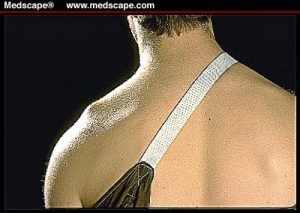 Symptoms of a Shoulder Separation