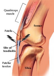 Patellar Tendonitis – Orland Park Orthopedics