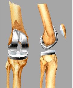 Solved] The contact between femoral and tibia components in knee joint