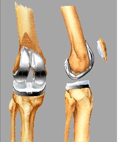 knee joint replacement devices