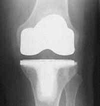 Rotating platform total knee replacement